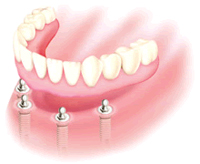 全ての歯を失った際の治療