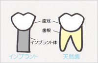 ブリッジ・入れ歯との違い