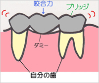 ブリッジ・入れ歯との違い