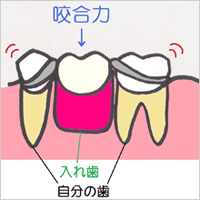 ブリッジ・入れ歯との違い