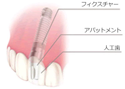 インプラントのしくみ